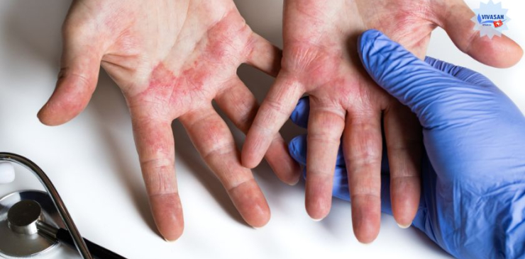 Come combattere la dermatite seborroica in modo naturale